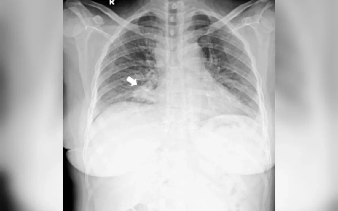 cançigo, neoplasia, pulmonar;